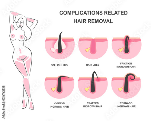 Ingrown hair, problems after hair removal, complications after epilation or depilation. Complications related hair removal.