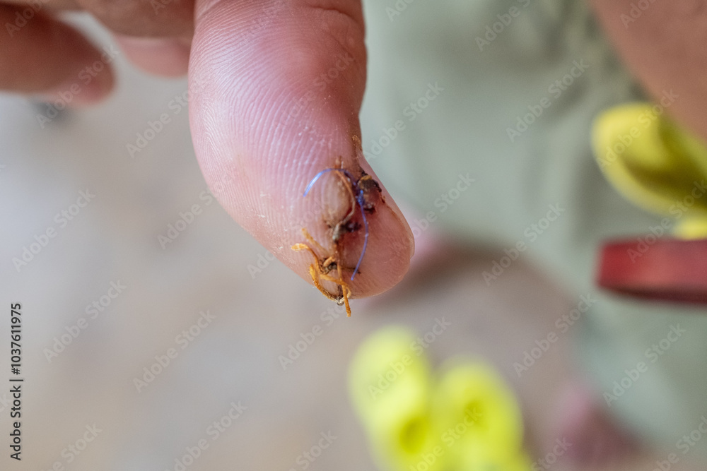 Obraz premium Injured thumb finger with a cut and four stitches