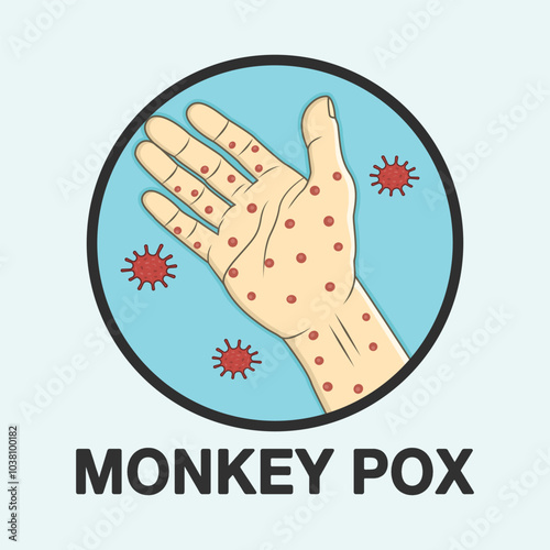 Monkey pox virus. painful rash on the hands vector illustration