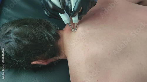 Shoulder muscle twitching when stimulated with an acupuncture pen point stimulator during an electro dry needling physiotherapy session  photo