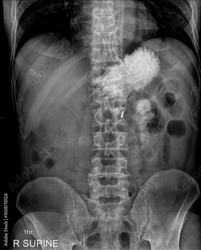 An abdominal radiograph showing a barium examination of the bowel one hour after the contrast medium was swallowed.