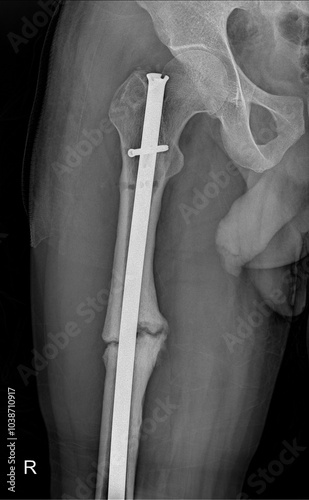 X-ray of Intramedullary Implant in Femur for Assessing Fracture Fixation and Healing photo