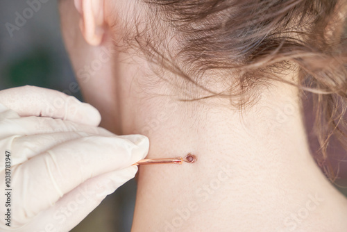 Fotografija Woman examing her abnormal mole