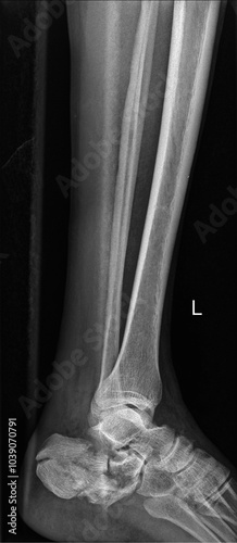 X-ray Ankle joint Lateral view showing calcaneus fracture photo