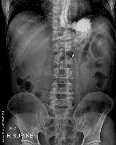 Abdomen radiograph showing barium examination  photo