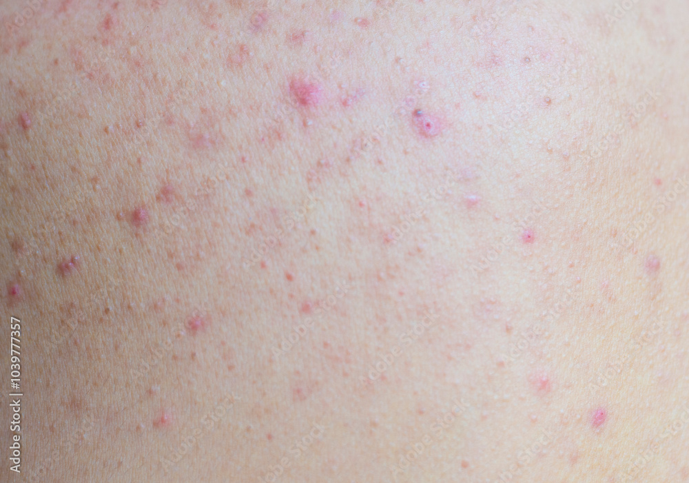 Fototapeta premium Close up of a patient's skin. Red bumps, itchy rash.