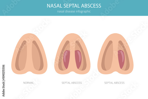 Nasal septal abscess. Nasal diseases. Medical infographic design. Vector illustration