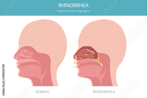 Rhinorrhea, rhinitis. Nasal diseases. Medical infographic design. Vector illustration