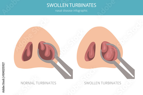 Swollen turbinates. Nasal diseases. Medical infographic design. Vector illustration