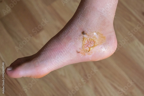 A close-up view of a persons foot showing healed skin from a burst blister with a yellow spot, in the process of drying. photo