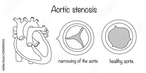 Aortic stenosis