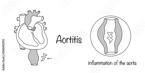 Aortitis