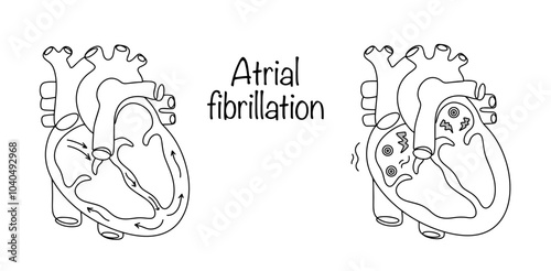 Atrial fibrillation