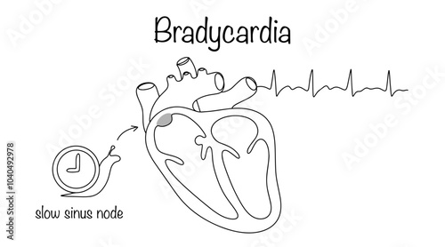 Bradycardia