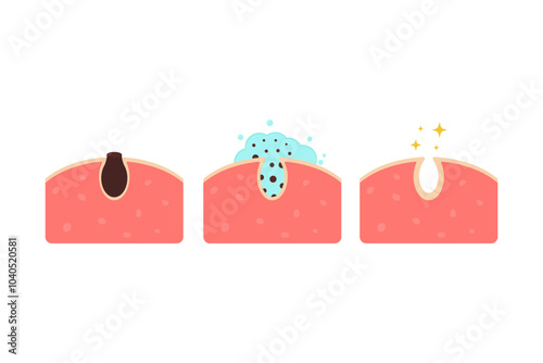 Cleaning clogged pores process flat illustration. Blackheads removal, skin cleaning foam, skincare. Can be used for topics like cosmetology, cosmetics.