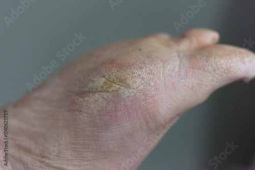 Foto Close up of dry cracked skin on foot