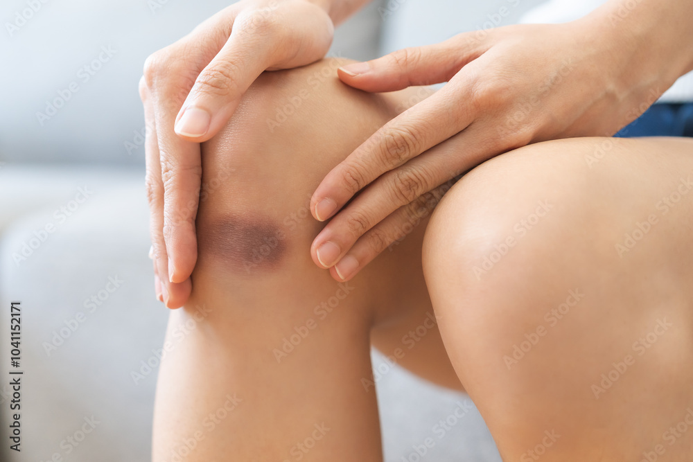 Fototapeta premium Close up of stain bruise wound on leg, contusion asian young woman, girl on joint knee from an accident fell down, hand in healing injury by massage hematoma blood. Extravasation blue, purple on skin.