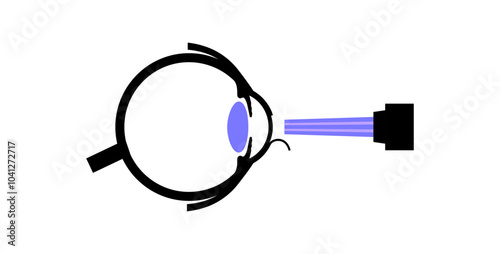 Lasik eye surgery