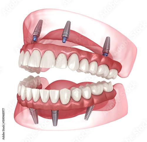 Dental prosthesis based on 4 implants. Dental 3D illustration photo