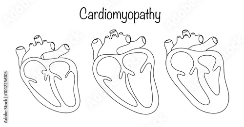 Cardiomyopathy