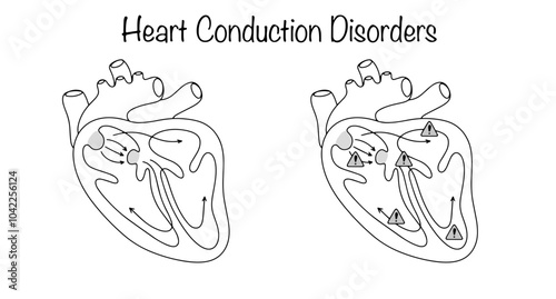 Heart Conduction Disorders