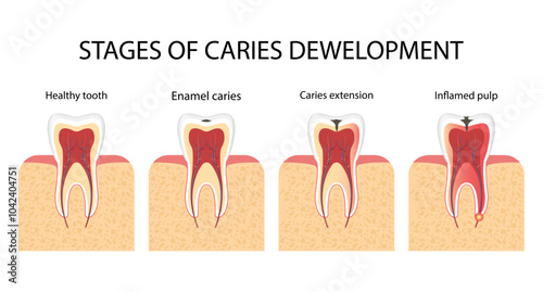 Types of caries in humans. Superficial, median, deep caries., and pulp
