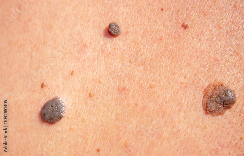 Nevus close-up. Mole on human skin. Irregular birthmark. photo