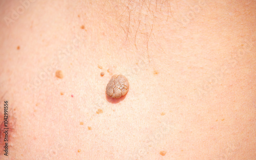 Nevus close-up. Mole on human skin. Irregular birthmark. photo