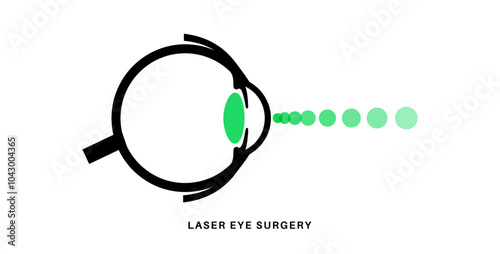 Lasik eye surgery