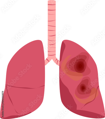 Lung disease. Respiratory disease illustration.