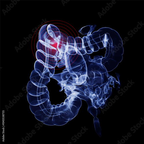 Humen colon with injury x-ray film on a dark blue background