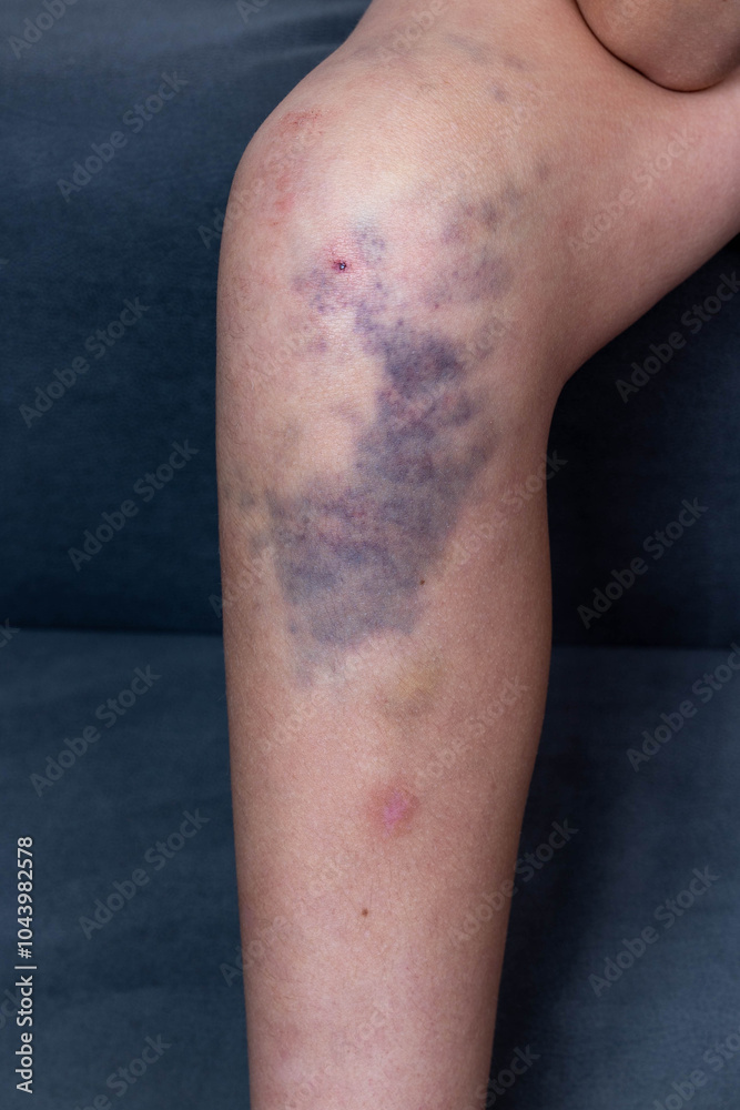 Fototapeta premium Woman showing large bruise on leg from injury