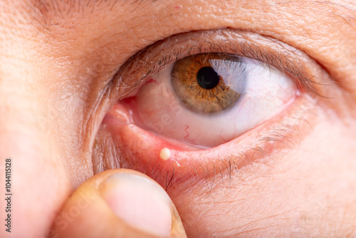 Foto Ophthalmic hordeolum, close-up of an adult male eye with a stye (ophthalmic hordeolum), selective focus