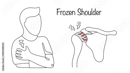 Frozen Shoulder