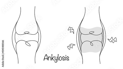 Ankylosis