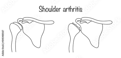 Shoulder arthritis