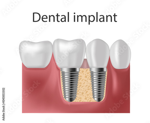 Dental implant. Screw prosthesis, orthodontic dental implantation