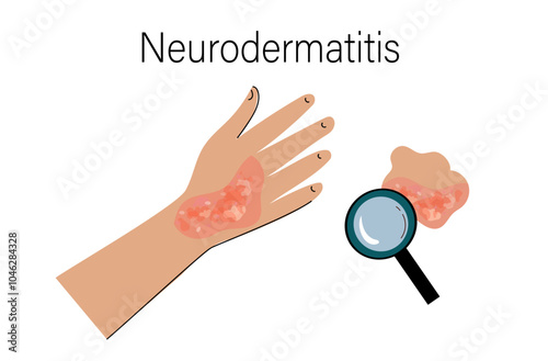 people suffers from atopic dermatitis. Neurodermatitis symptoms and reasons infographic. Human skin infection dermatitis diagnosis. Vector doodle hand drawn flat illustration	
