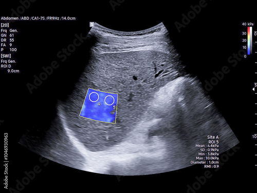 Ultrasound scan of the upper abdomen showing signs of chronic liver parenchymal disease. Ideal for medical education and diagnostic purposes in liver health. photo