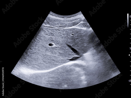 Ultrasound scan of the upper abdomen showing signs of chronic liver parenchymal disease. Ideal for medical education and diagnostic purposes in liver health. photo