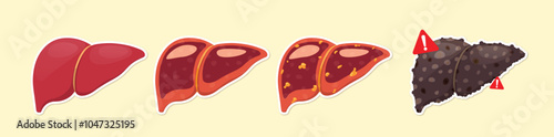 Stages of liver disease