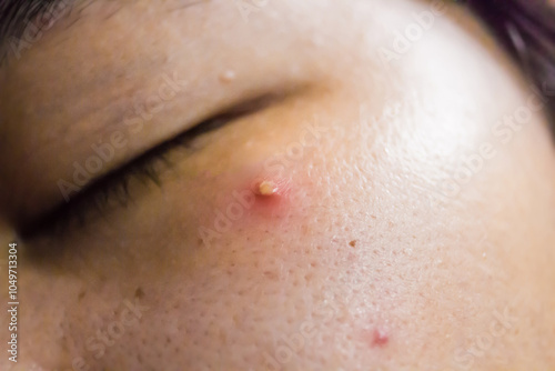 Close up of female face with red problematic acne skin and scars.