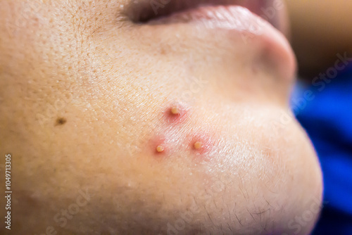 Close up of female face with red problematic acne skin and scars.