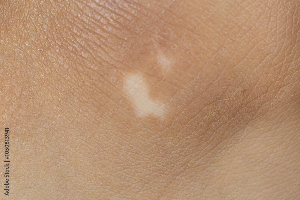 Fototapeta premium The image showcases a foot affected by vitiligo, with contrasting light and dark skin tones. Ideal for awareness and dermatological studies