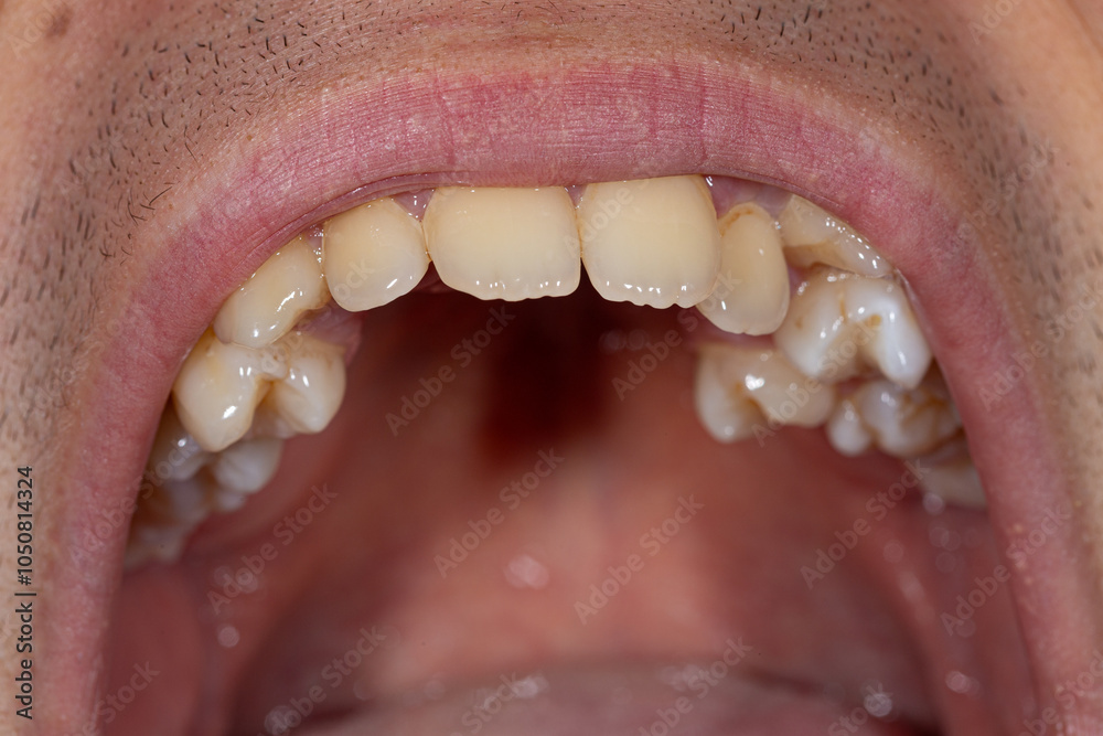 Obraz premium Open mouth view displaying misaligned teeth, focusing on jaw irregularities and the importance of proper dental alignment.