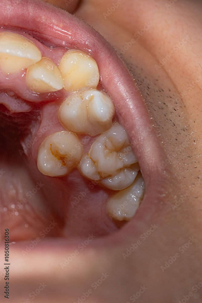Obraz premium Close-Up of Misaligned Teeth