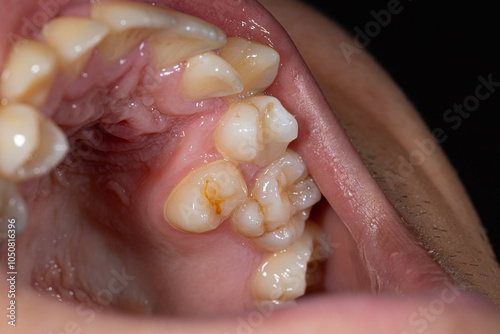 Close-up view of misaligned teeth showing jaw malocclusion and irregular dental alignment in an open mouth, highlighting dental health issues photo