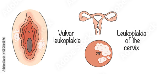 Vulvar leukoplakia. Leukoplakia of the cervix