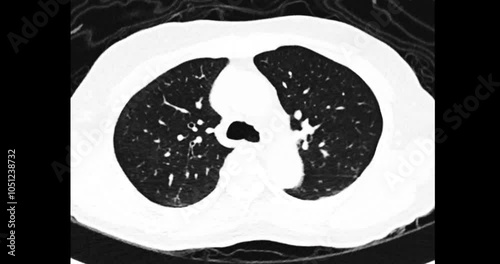 CT Chest or CT Scan of Lung  View for diagnosis TB,tuberculosis and coronavirus or covid-19 .