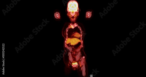 A PET-CT scan is a diagnostic imaging technique combining positron emission tomography (PET) and computed tomography (CT) in cancer diagnosis and staging. 
